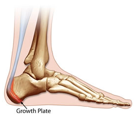 intense pain in heel