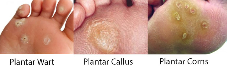 plantar callus bottom of foot