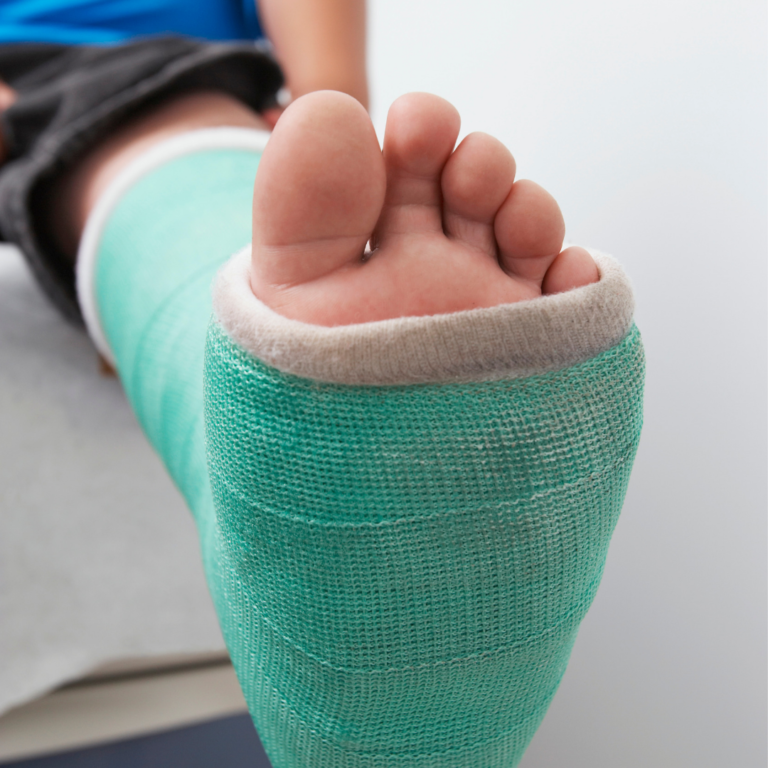 Forefoot Fractures – Corrigan Podiatry