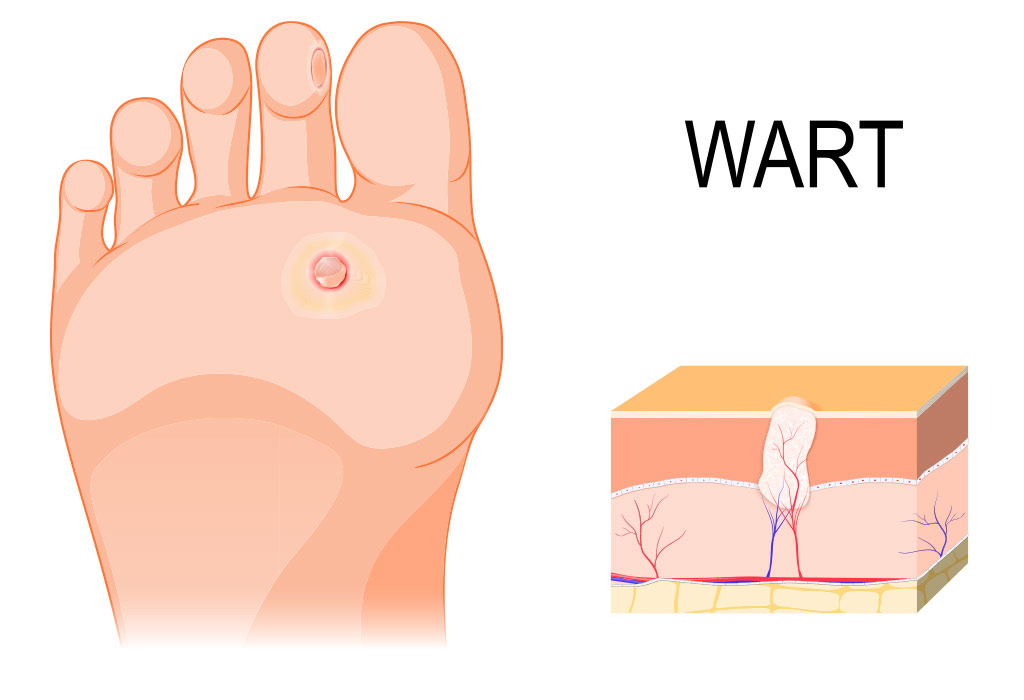 plantar-warts-corrigan-podiatry